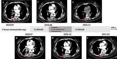 Case Report: An “Immune-Cold” EGFR Mutant NSCLC With Strong PD-L1 Expression Shows Resistance to Chemo-Immunotherapy